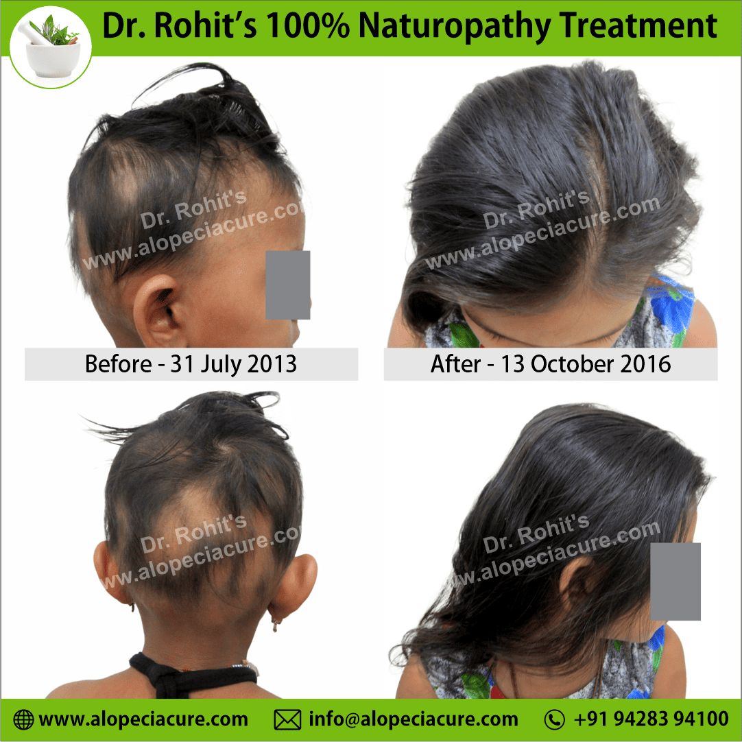 alopecia areata treatment