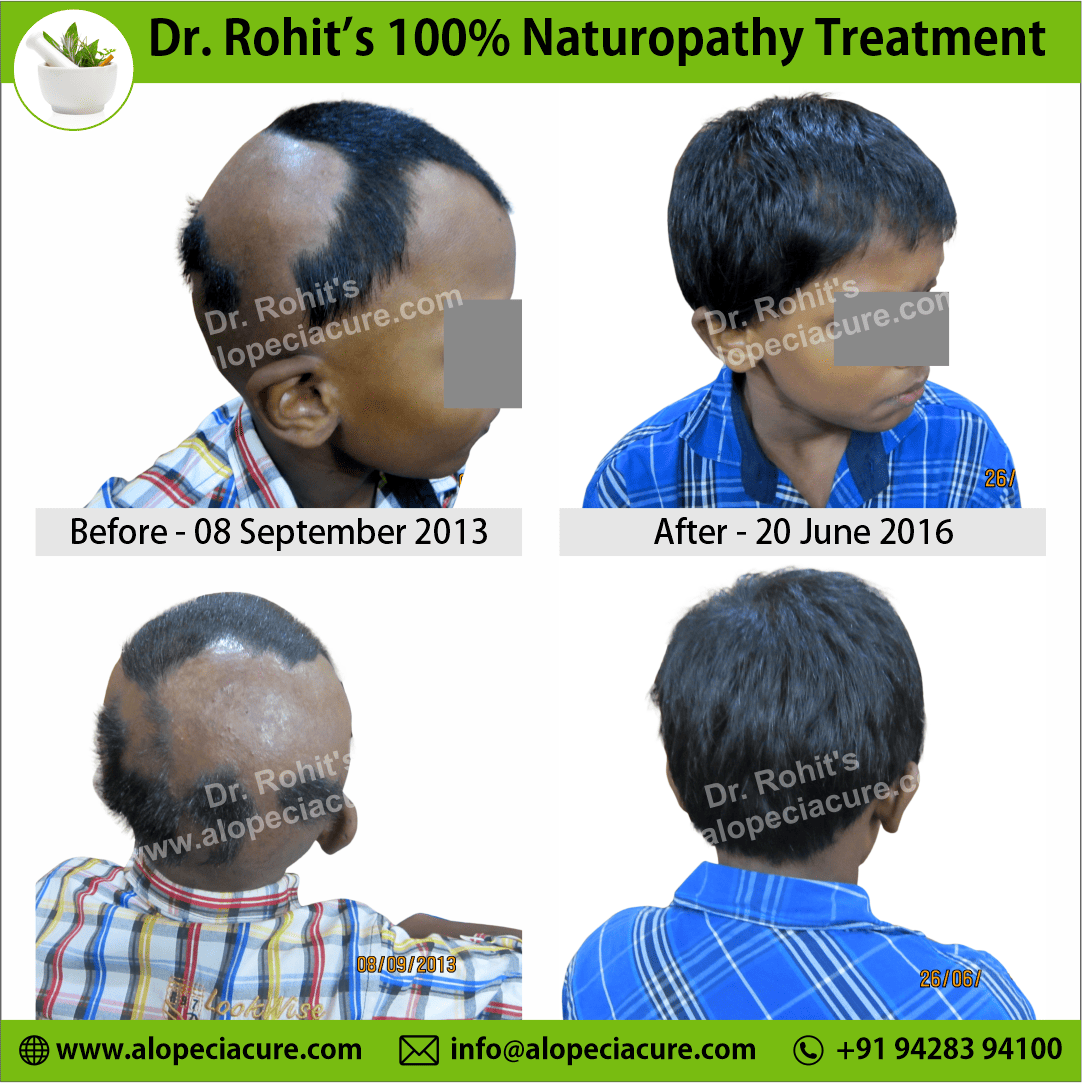 ophiasis alopecia areata treatment