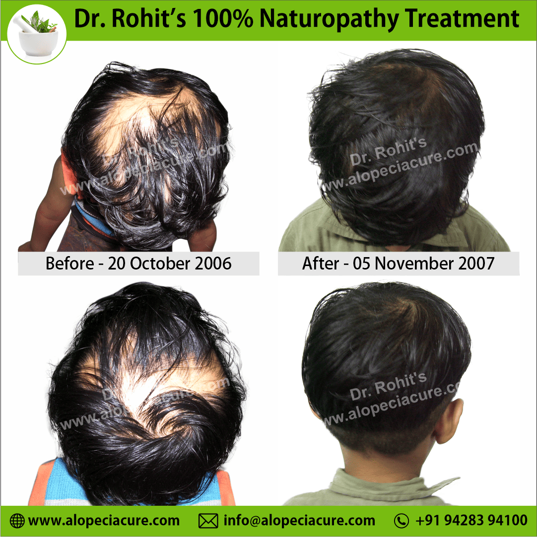 alopecia areata treatment