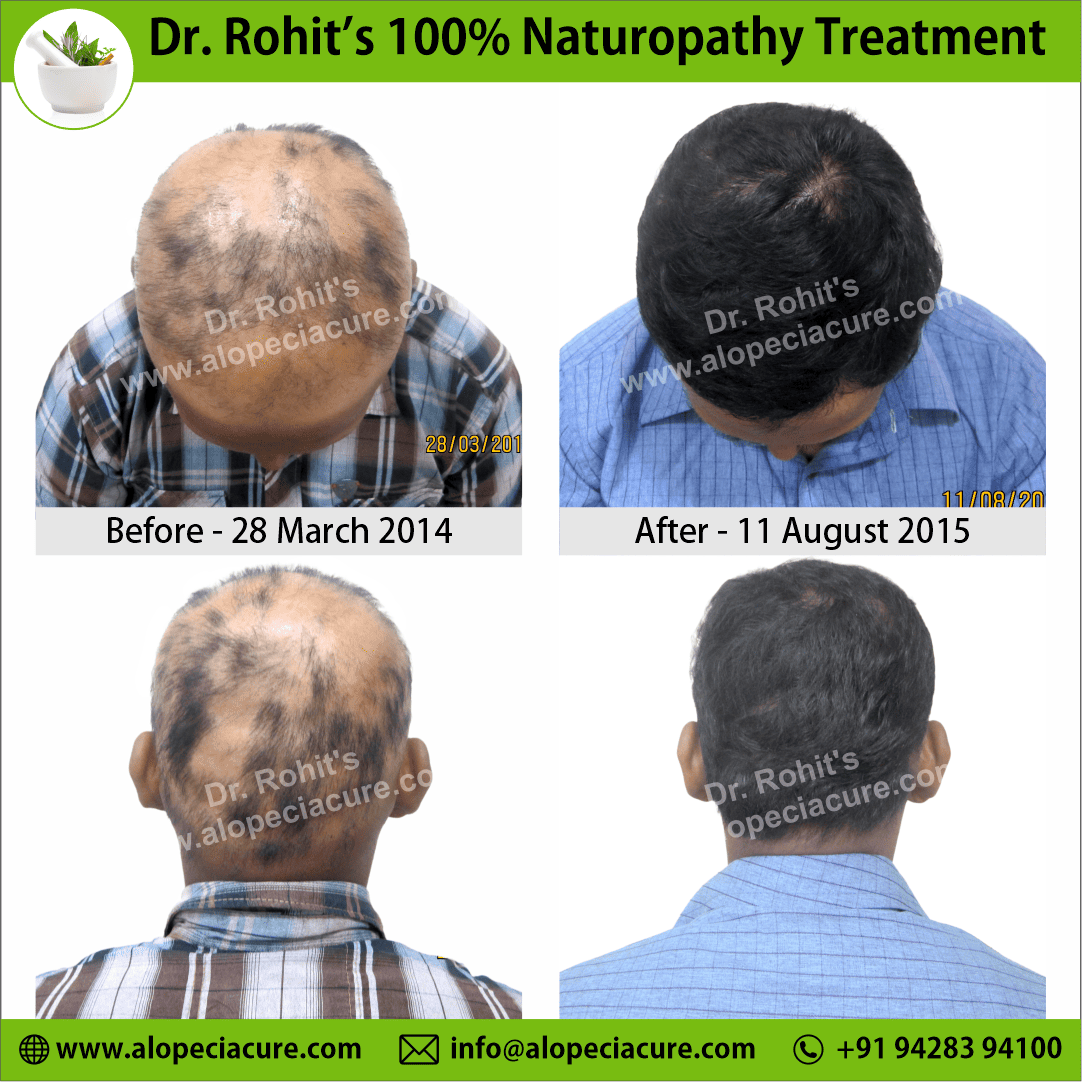 alopecia areata treatment