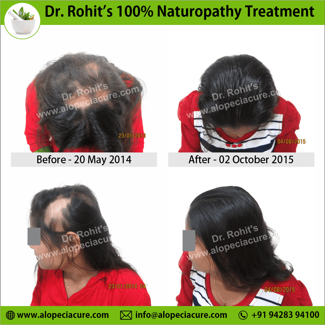 ophiasis alopecia areata treatment