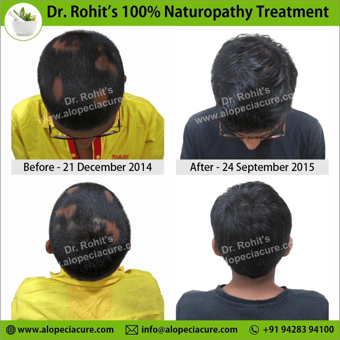 alopecia areata treatment