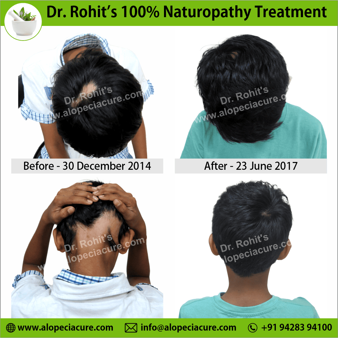 ophiasis alopecia areata treatment