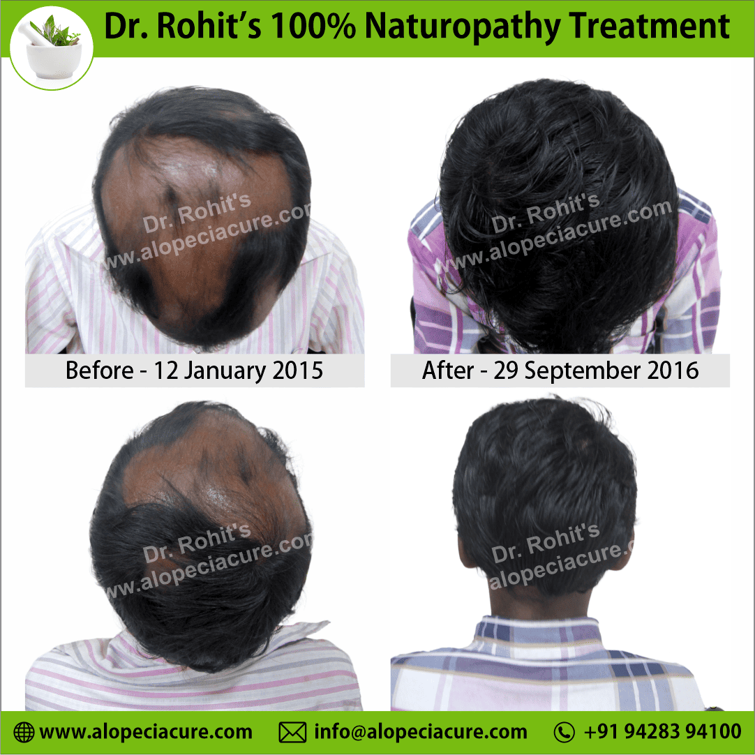 alopecia areata treatment