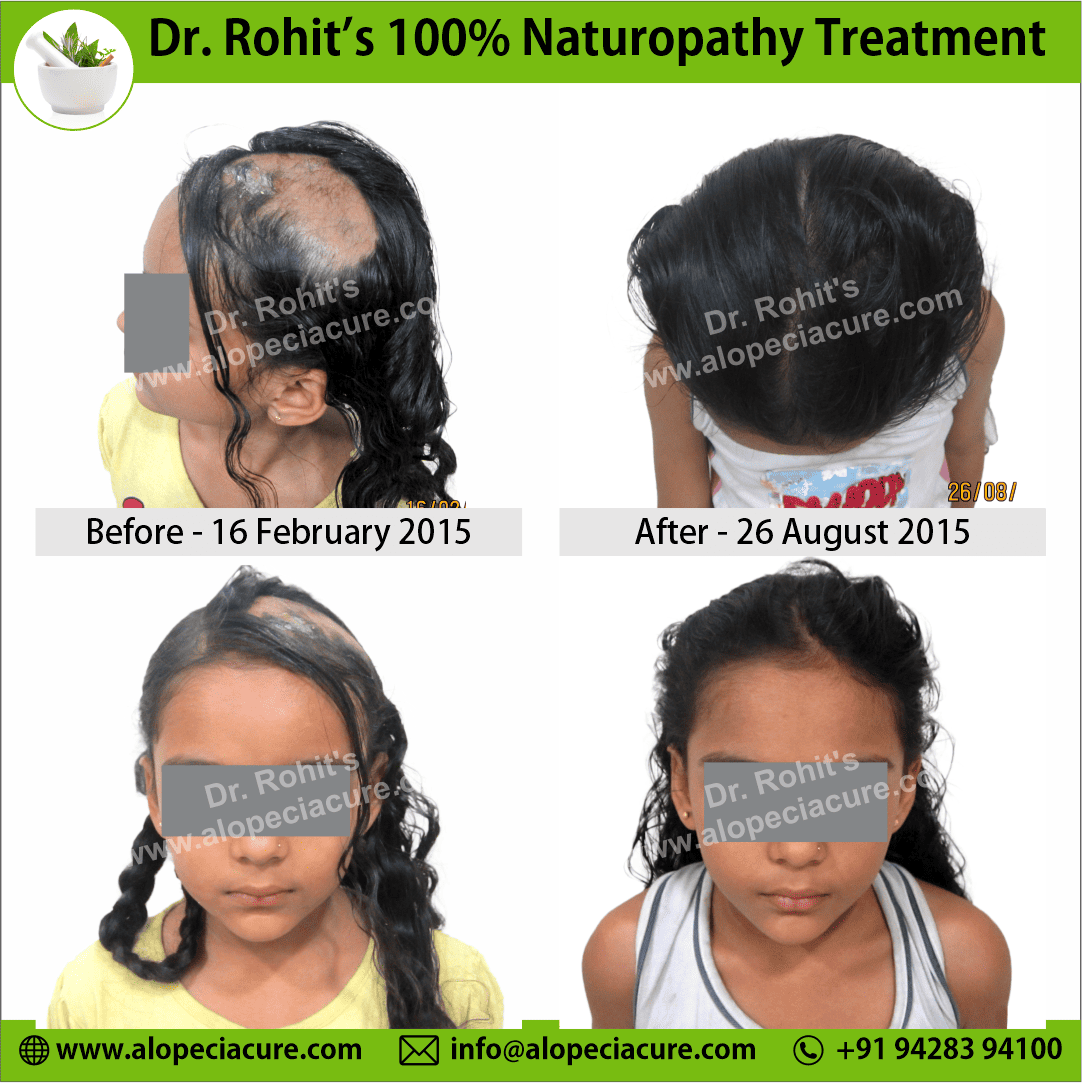 Ophiasis alopecia areata treatment