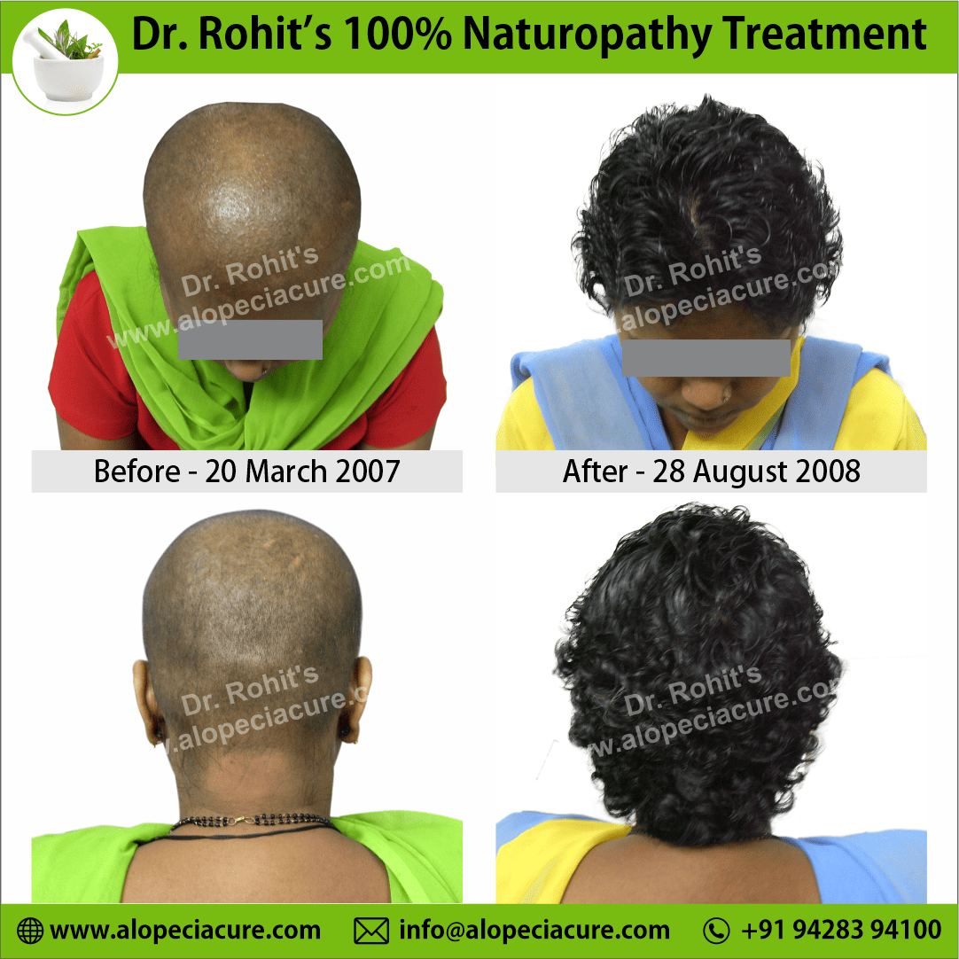 Chemotherapy hair loss