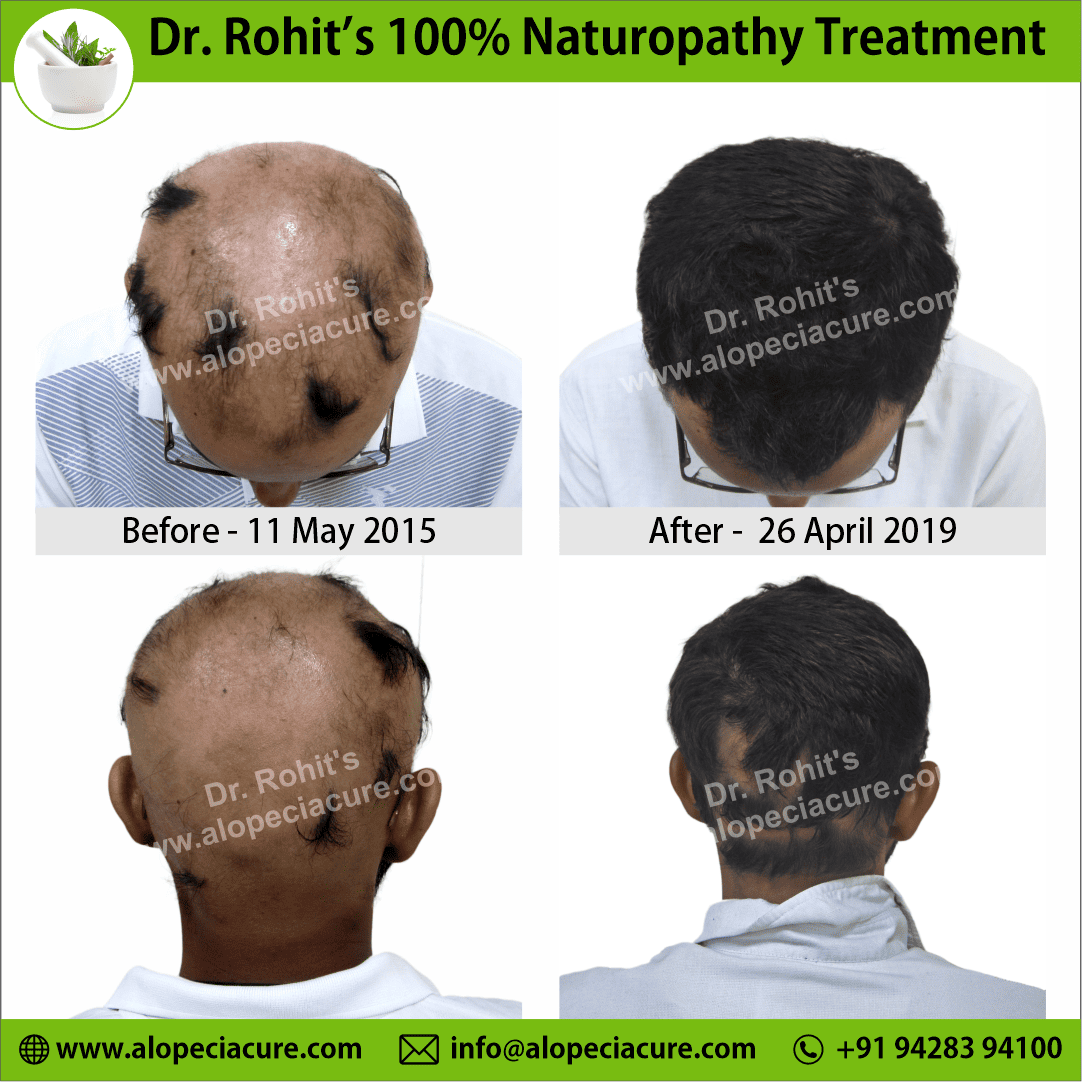 alopecia areata treatment