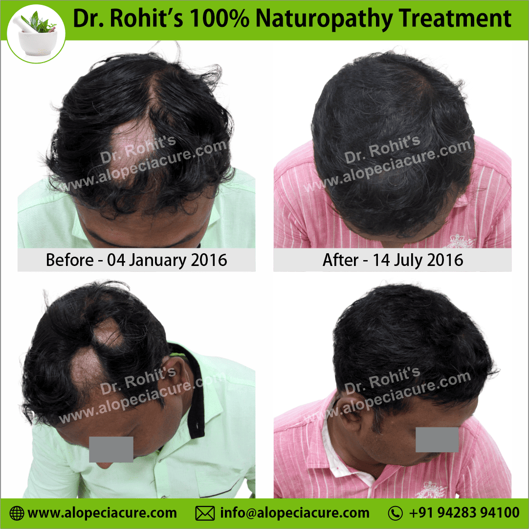 alopecia areata treatment