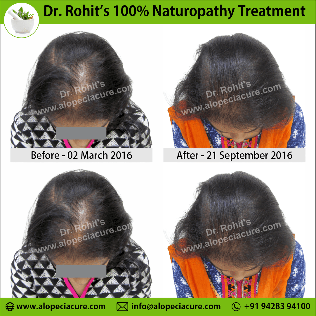 ophiasis alopecia areata treatment