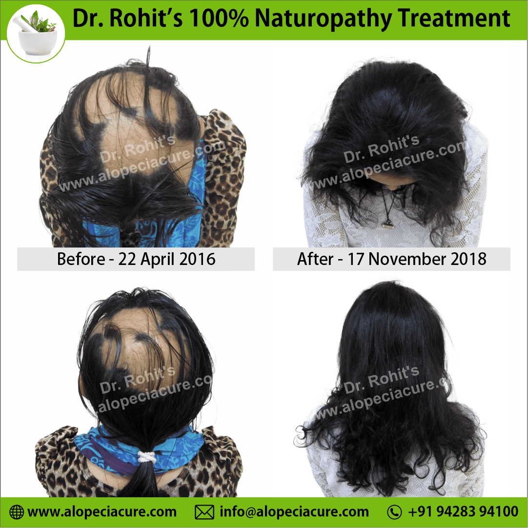 ophiasis alopecia areata treatment