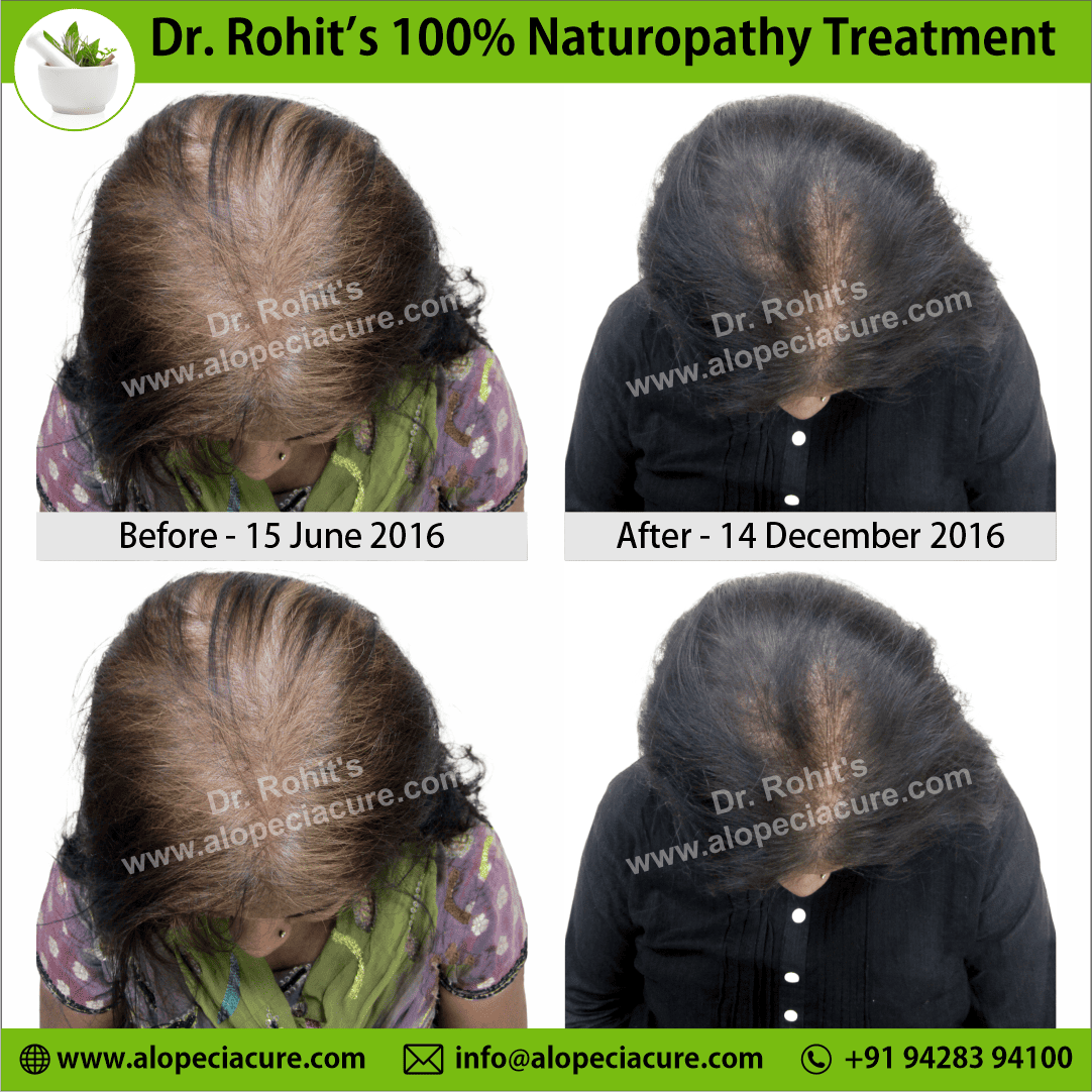 Female Pattern Baldness treatment