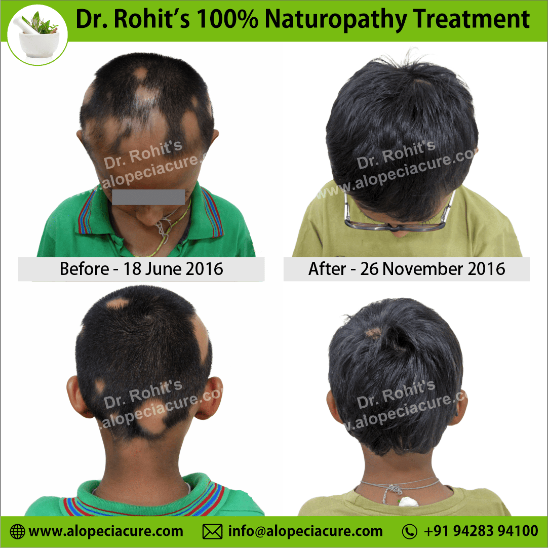 prograssive alopecia areata treatment