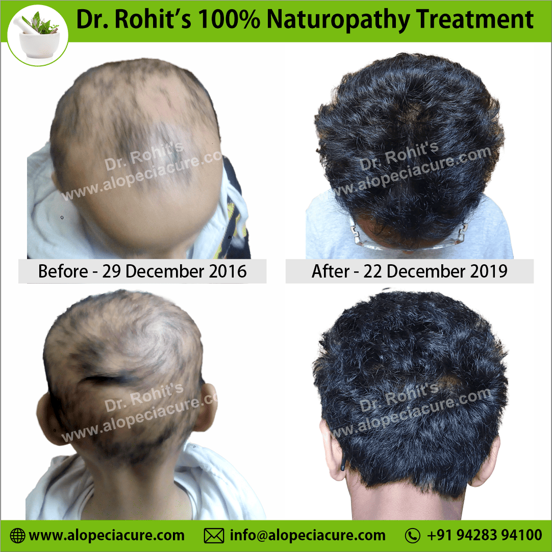 chronic alopecia areata treatment