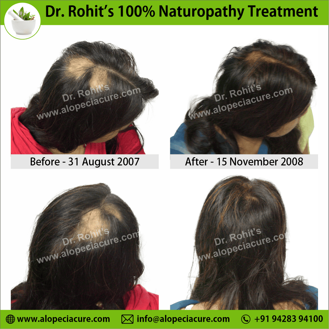 alopecia areata treatment