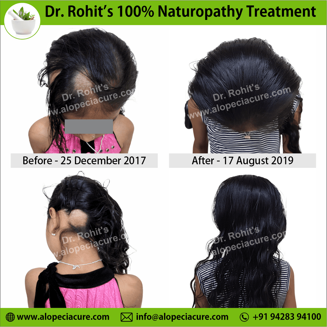 ophiasis alopecia areata treatment