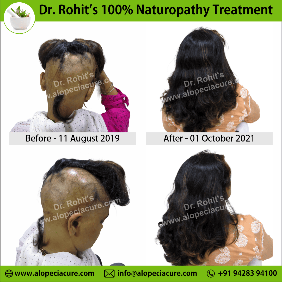 alopecia barbae treatment