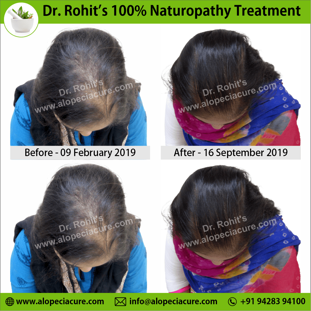 female hair loss treatment