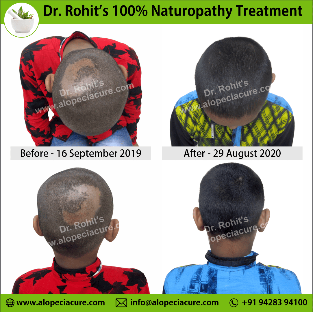 alopecia areata treatment