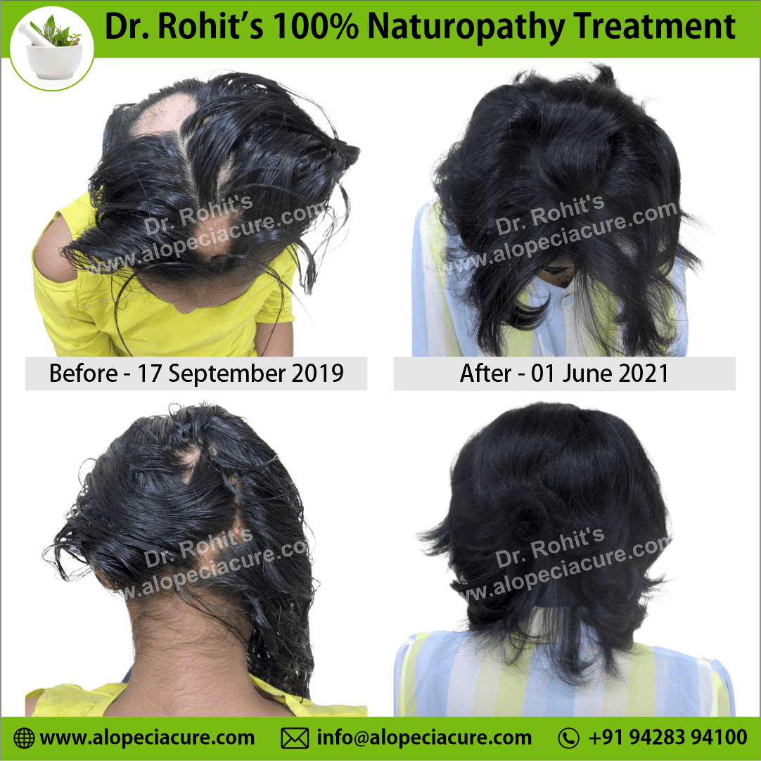 alopecia areata treatment