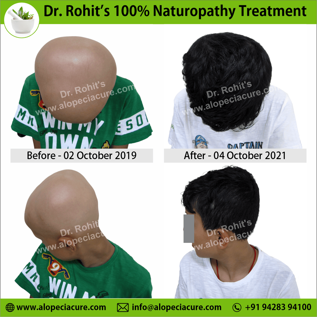 alopecia universalis treatment