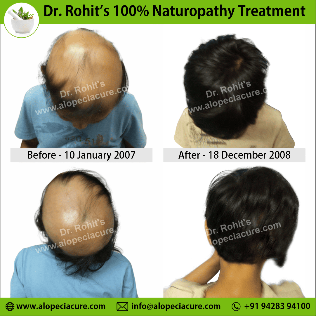 alopecia areata treatment