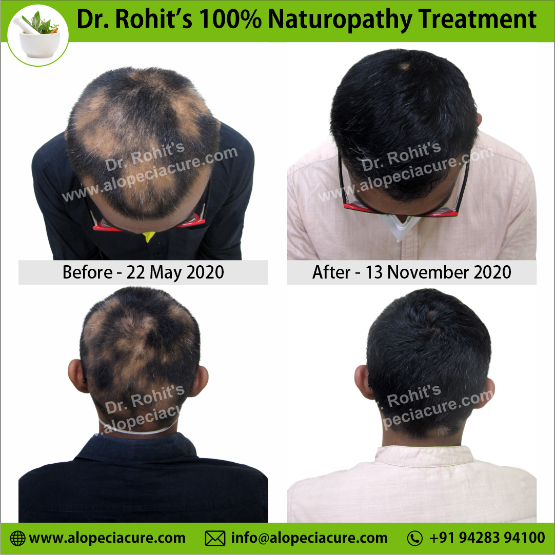 prograssive alopecia areata treatment