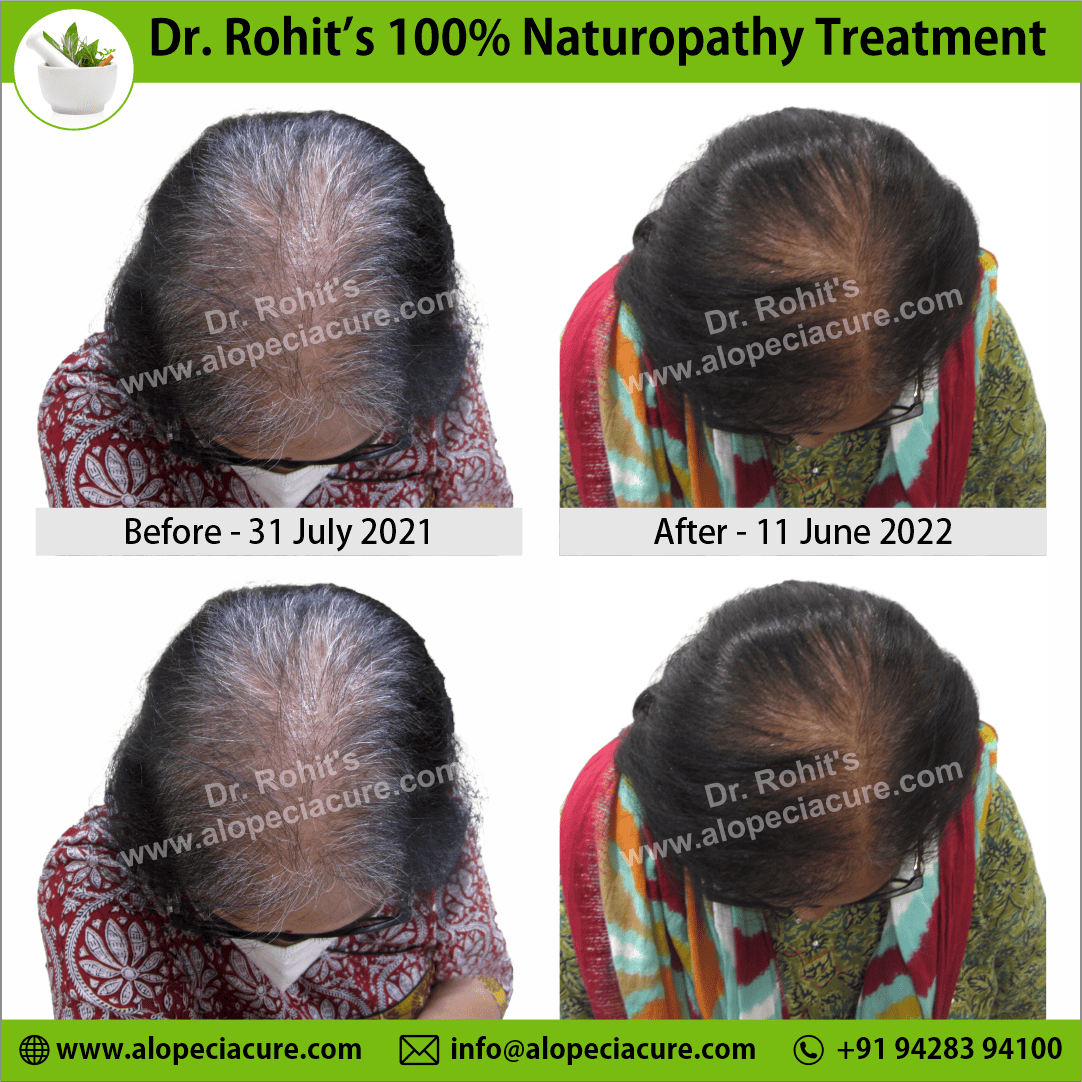 female hair loss treatment