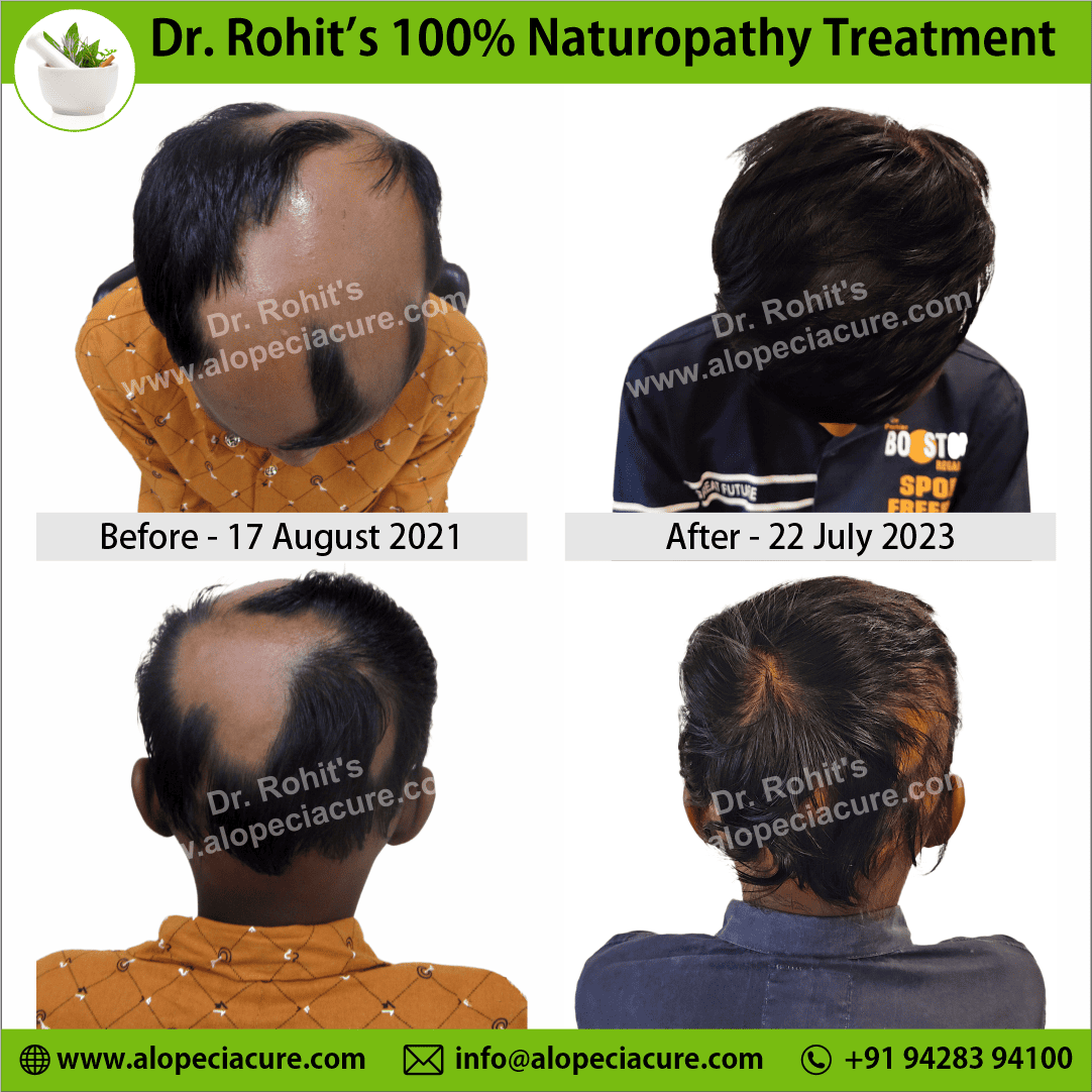 ophiasis alopecia areata treatment