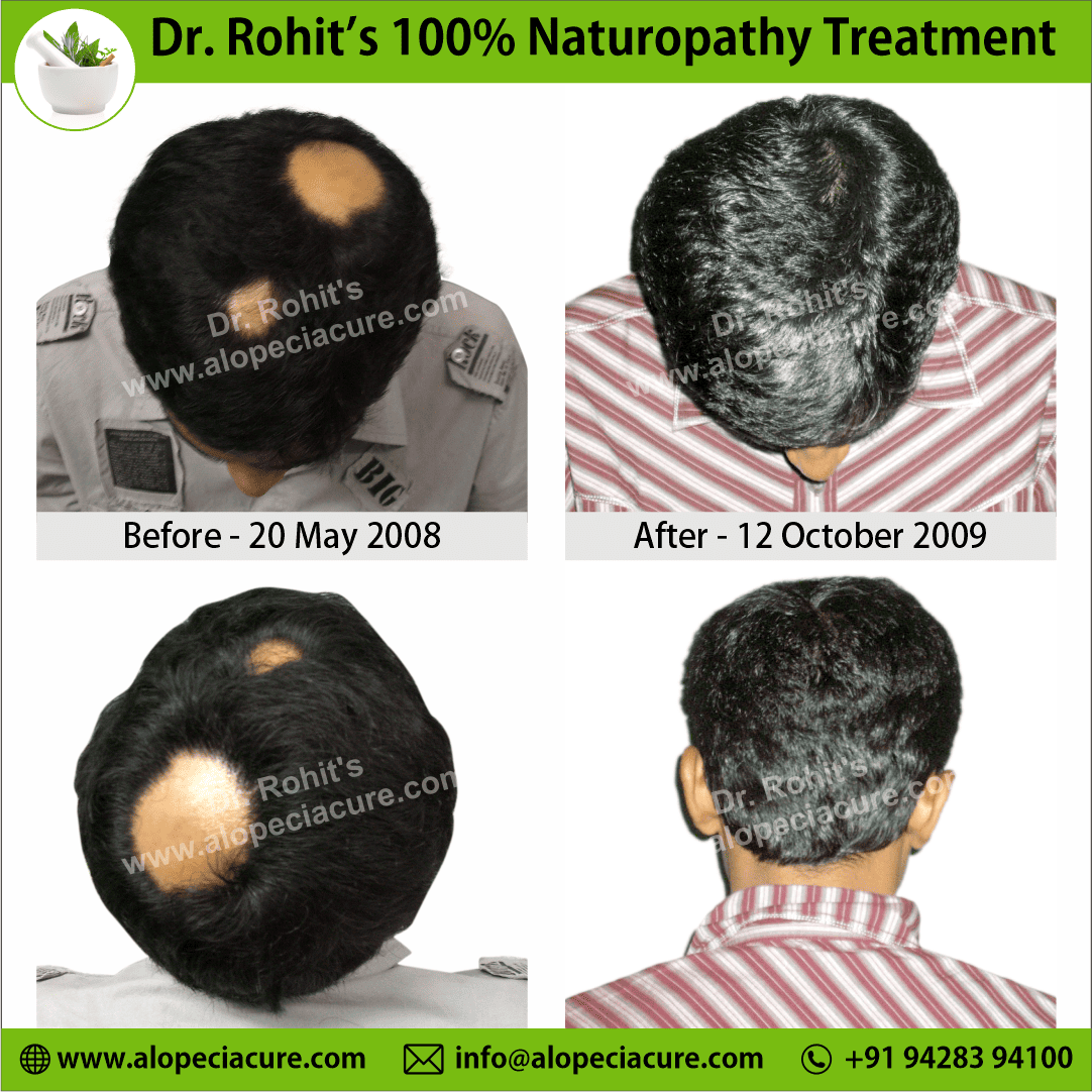 alopecia areata treatment