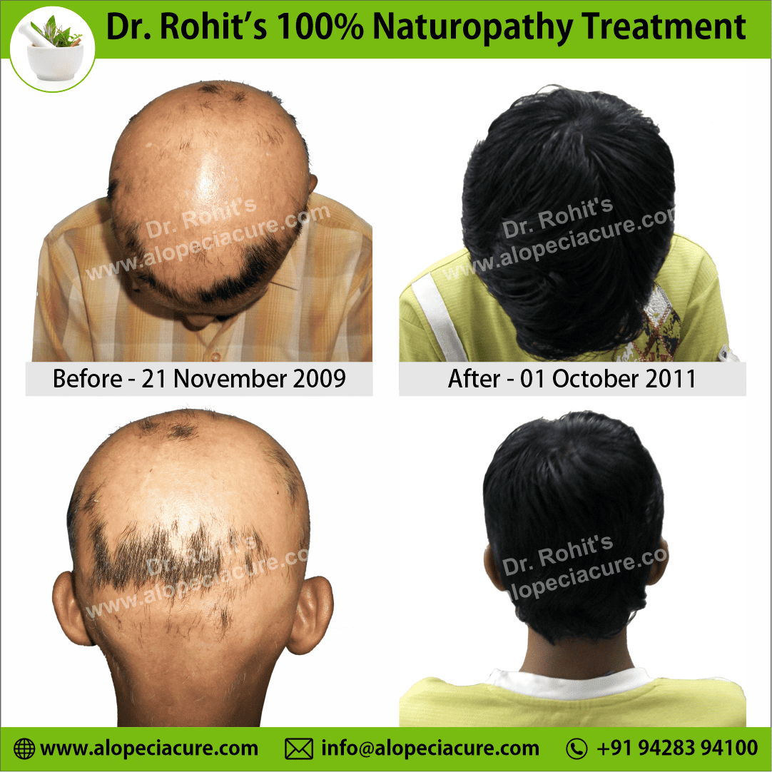 alopecia areata treatment