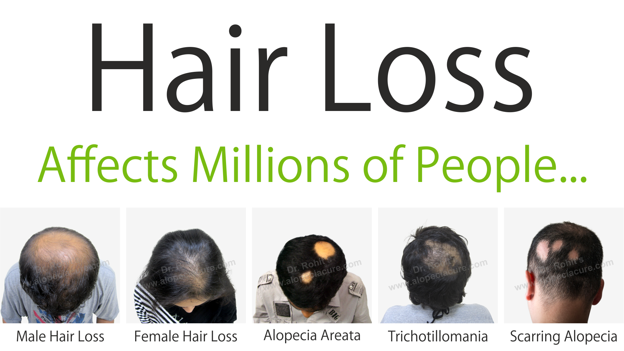 alopecia treatment center